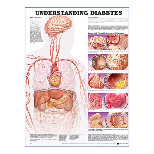 Understanding Diabetes plastlaminerad anatomisk plansch
